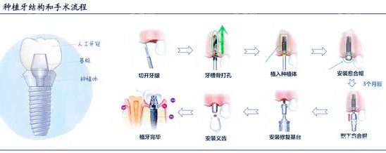 最新科技在装牙领域的应用与革新