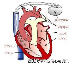 最新款起搏器，重塑心脏健康的新希望